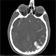 CT s kontrastní látkou − AVM parietálního laloku vlevo