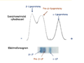 Obr. 8 Elektroforéza lipoproteinů se zvýšenou pre-β-frakcí