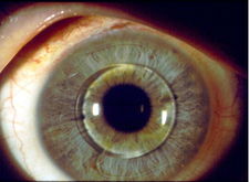 Oko s implantovanou fakickou předněkomorovou nitrooční čočkou