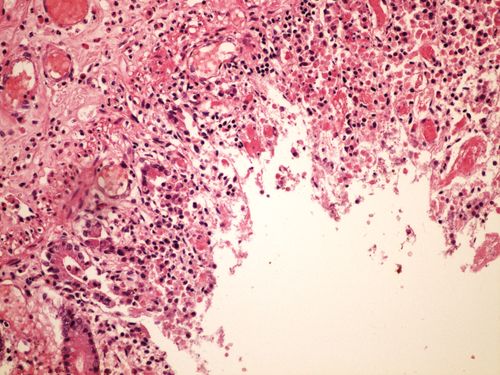 Hemorrhagic necrosis colon hemoragicka infarzace streva 20x.jpg