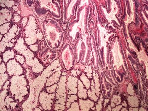 Invasive cancer arising in adenoma kancerisovany adenom tlusteho streva 4x.jpg