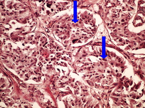 L11-4 pheochromocytoma feochromocytom 20x oznaceno.jpg