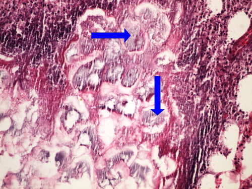 L7-13 pancreatitis 20x oznaceno.jpg