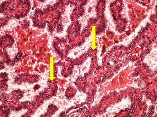 L 11-10 papillary carcinoma thyreoid papilarni karcinom stitne zlazy 20x oznaceno.jpg