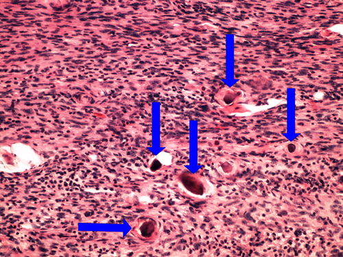 L 12-8 meningioma meningeom s psammomaty 20x oznaceno.jpg