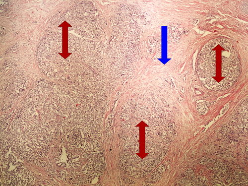 L 7-14 neuroendocrine tumor neuroendokrinni tumor 4x oznaceno.jpg