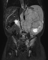MRI snímek – neuroblastom v retroperitoneu u 2leté pacientky.