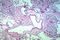 Granulomy přiléhající k fibróznímu septu