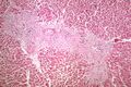 Granulomy a fibróza v oblasti jaterní trias