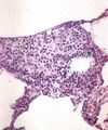 5. Negranulomatózní intersticiální pneumonie/alveolitida. Větší kolekce makrofágů s příměsí lymfocytů. Rostoucí granulom.