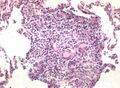 6. Negranulomatózní intersticiální pneumonie/alveolitida. Slabě ohraničená formace makrofágů a obrovských mnohojaderných buněk. Rostoucí granulom.