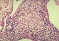 9. Pokročilá fáze formace granulomu. Kompaktní,organizovaná kolekce makrofágů/epiteloidních buněk s periferním lemem lymfocytů.