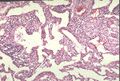 11. Negranulomatózní intersticiální pneumonie/alveolitida. Šipky ukazují na formované granulomy.