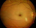 Třešňová skvrna – uzávěr a. centralis retinae