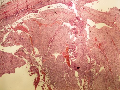 Urothelial papillocarcinoma urotelialni papilokarcinom 4x.jpg