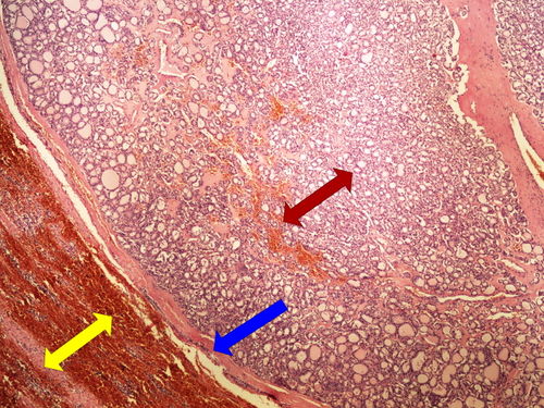 Z10-10 folicular adenoma thyreoid folikularni adenom stitne zlazy 4x oznaceno.jpg