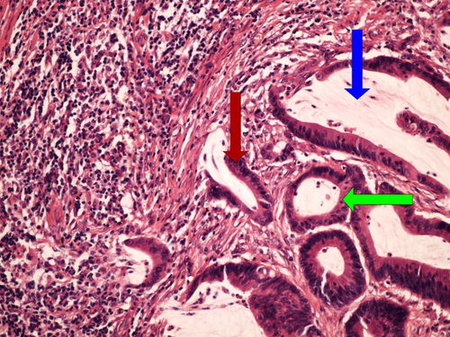 Z10-13 tubular adenocarcinoma tubularni adenokarcinom 20x oznaceno.jpg