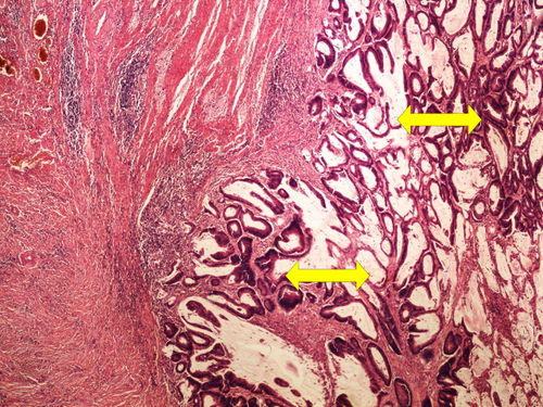Z10-13 tubular adenocarcinoma tubularni adenokarcinom 4x oznaceno.jpg