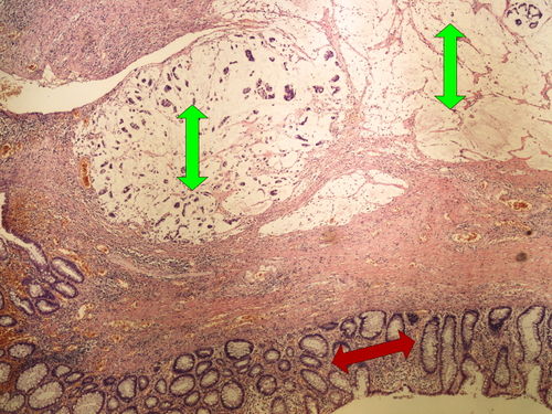 Z10-15 mucinous carcinoma gelatinosni karcinom 4x oznaceno.jpg