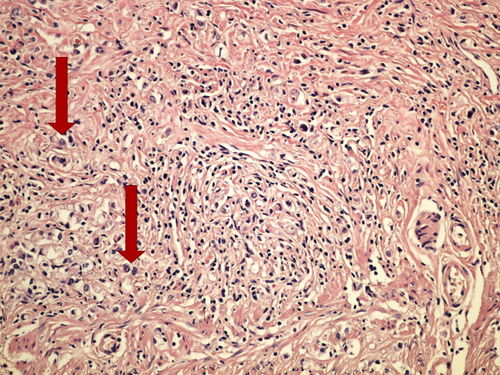Z10-16 diffuse carcinoma difusni adenokarcinom 20x oznaceno.jpg