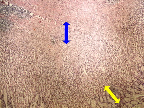 Z10-16 diffuse carcinoma difusni adenokarcinom 4x oznaceno.jpg