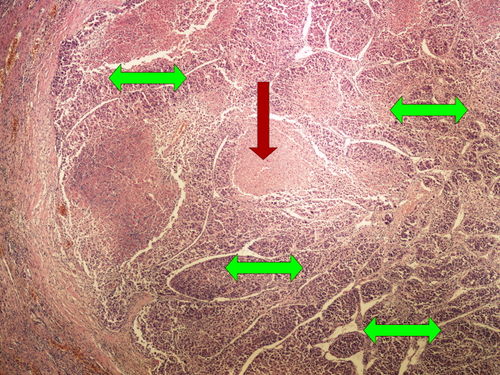 Z10-18 hepatocellular carcinoma heatocelularni karcinom 4x oznaceno.jpg