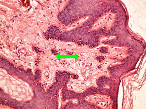 Z10-1 fibroepithelial polyp fibroepitelialni polyp 20x oznaceno.jpg