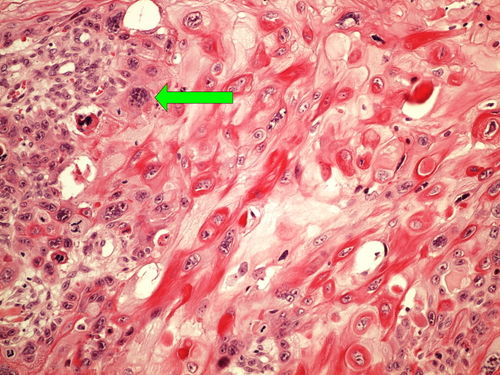 Z10-6 squamous cell carcinoma dlazdicovy karcinom 20x oznaceno.jpg