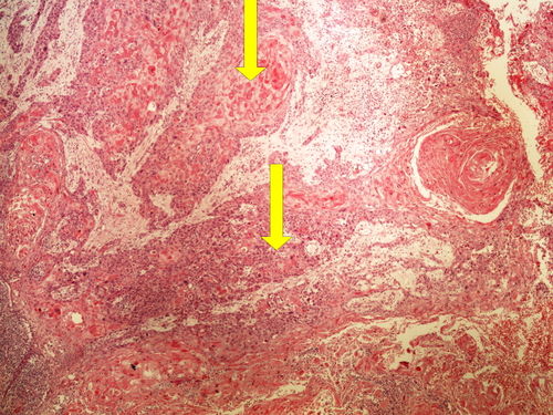 Z10-6 squamous cell carcinoma dlazdicovy karcinom 4x oznaceno.jpg