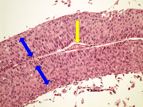 Z10-9 urothelial papillocarcinoma urotelialni papilokarcinom 20x oznaceno.jpg