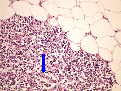 Z2-12 pancreas atrophy tukova atrofie pankreatu 20x oznaceno.jpg