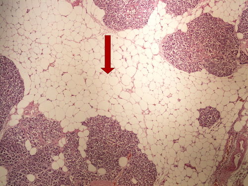 Z2-12 pancreas atrophy tukova atrofie pankreatu 4x oznaceno.jpg