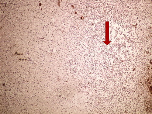 Z2-13 liquifactive necrosis kolikvacni nekroza 4x oznaceno.jpg