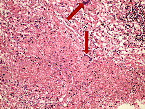 Z2-6 caseus necrosis lung kaseozni nekroza plice 20x oznaceno.jpg