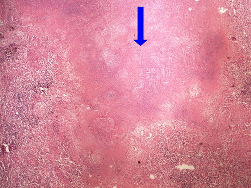 Z2-6 caseus necrosis lung kaseozni nekroza plice 4x oznaceno.jpg