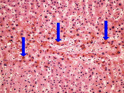 Z2-8 liver atrophy hneda atrofie jater20x oznaceno.jpg