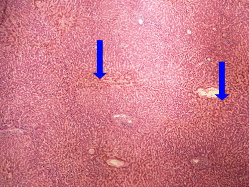 Z2-8 liver atrophy hneda atrofie jater 4x oznaceno.jpg