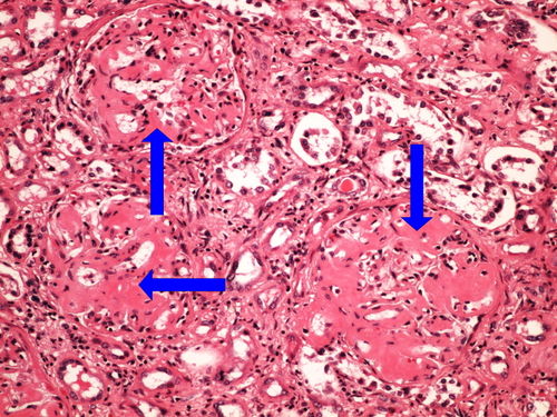 Z3-12 amyloidosis kidney amyloidoza ledviny HE 20x oznaceno.jpg