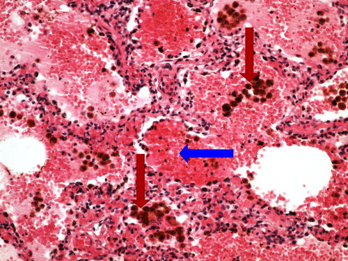 Z5-2 hemosiderin lung rezava indurace plic 20x oznaceno.jpg
