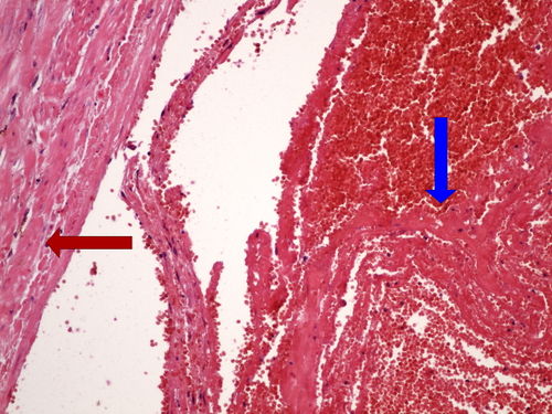 Z5-4 acute thrombosis cerstva tromboza 20x oznaceno.jpg