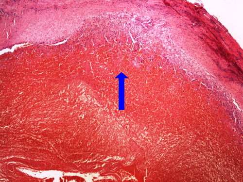 Z5-5 thrombosis with reparation tromboza v organizaci 4x oznaceno.jpg