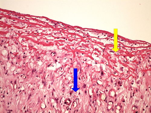 Z6-13 chronic skin ulcer granulacni tkan spodiny bercoveho vredu 20x oznaceno.jpg