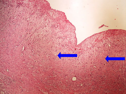 Z6-13 chronic skin ulcer granulacni tkan spodiny bercoveho vredu 4x oznaceno.jpg