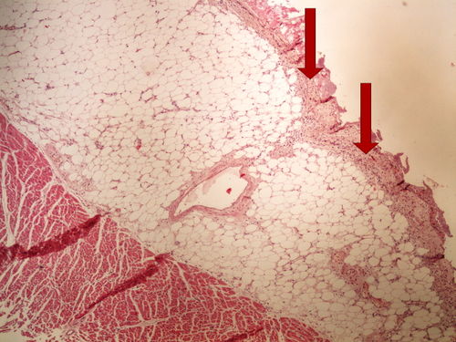 Z6-6 fibrinous pericarditis cerstva fibrinozni perikarditis 4x oznaceno.jpg