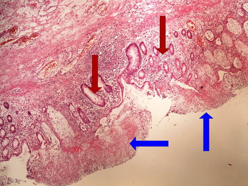 Z6-9 pseudomembranous colitis pablanova kolitis 4x oznaceno.jpg