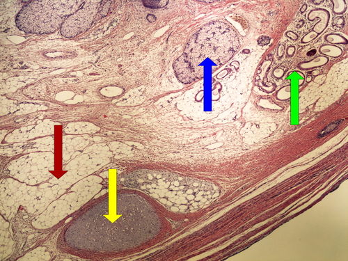 Z 11-11 teratoma ovary koetanni teratom ovaria 4x oznaceno.jpg