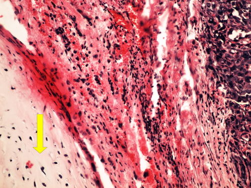 Z 11-12 mixed germinal tumor smiseny germinalni nador 20x oznaceno.jpg