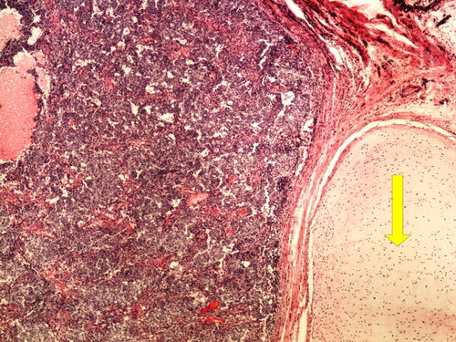 Z 11-12 mixed germinal tumor smiseny germinalni nador 4x oznaceno.jpg