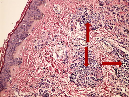 Z 11-6 intradermal mole intradermalni pigmentovy nevus 20x oznaceno.jpg
