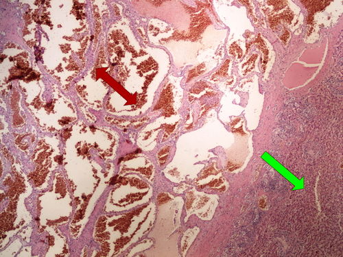 Z 8-10 cavernous haemangioma liver kavernosni hemangiom jater 4x oznaceno.jpg